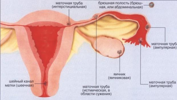 Внематочная беременность: какие назначают операции Как удаляется внематочная беременность на ранних сроках